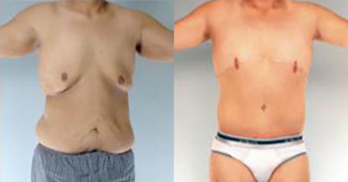 Before & After Tummy Tuck Case 363 View 1 View in Houston, TX