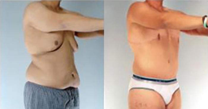 Before & After Tummy Tuck Case 363 View 2 View in Houston, TX