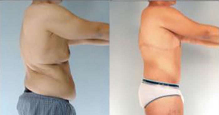 Before & After Tummy Tuck Case 363 View 3 View in Houston, TX