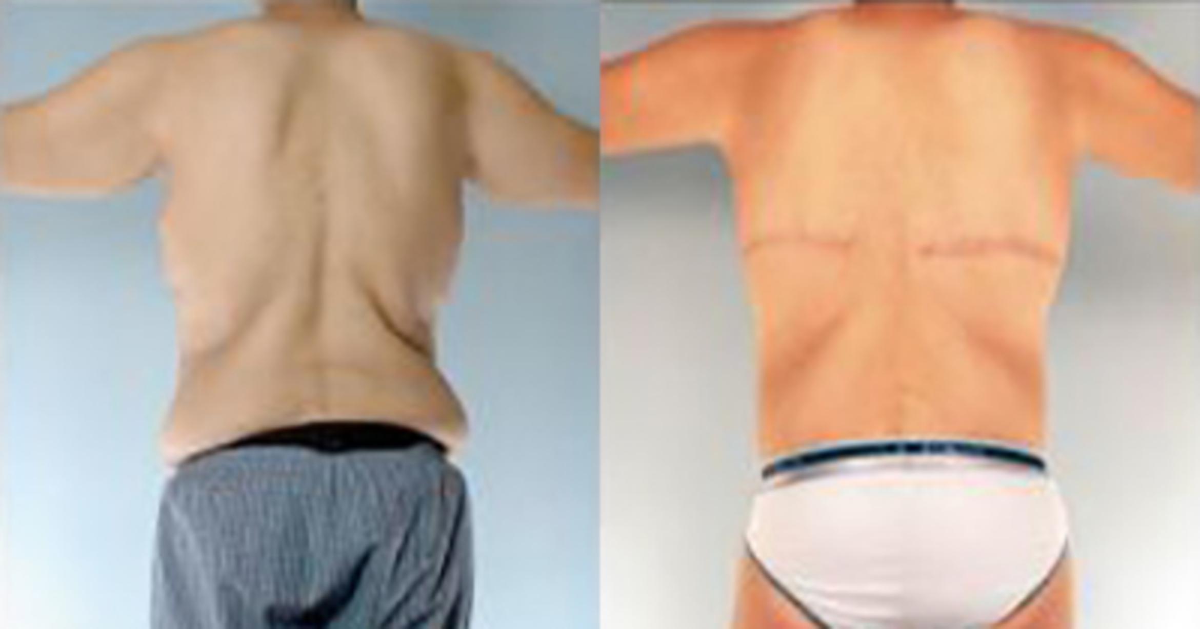 Before & After Tummy Tuck Case 363 View 4 View in Houston, TX