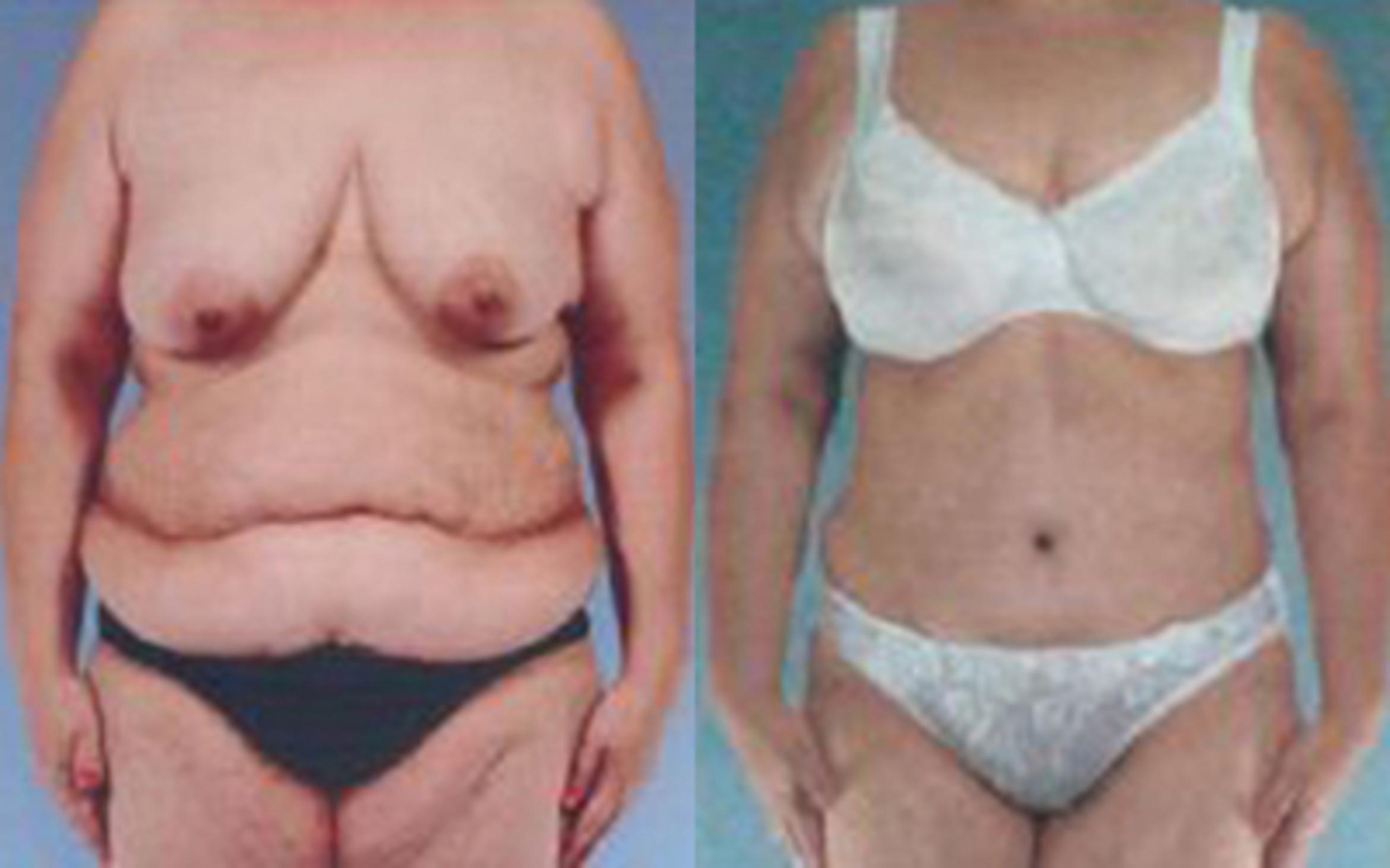 Before & After Tummy Tuck Case 37 View 1 View in Houston, TX