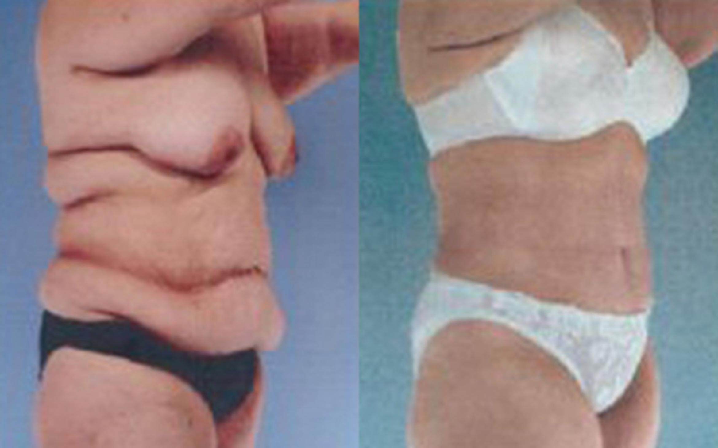 Before & After Tummy Tuck Case 37 View 2 View in Houston, TX