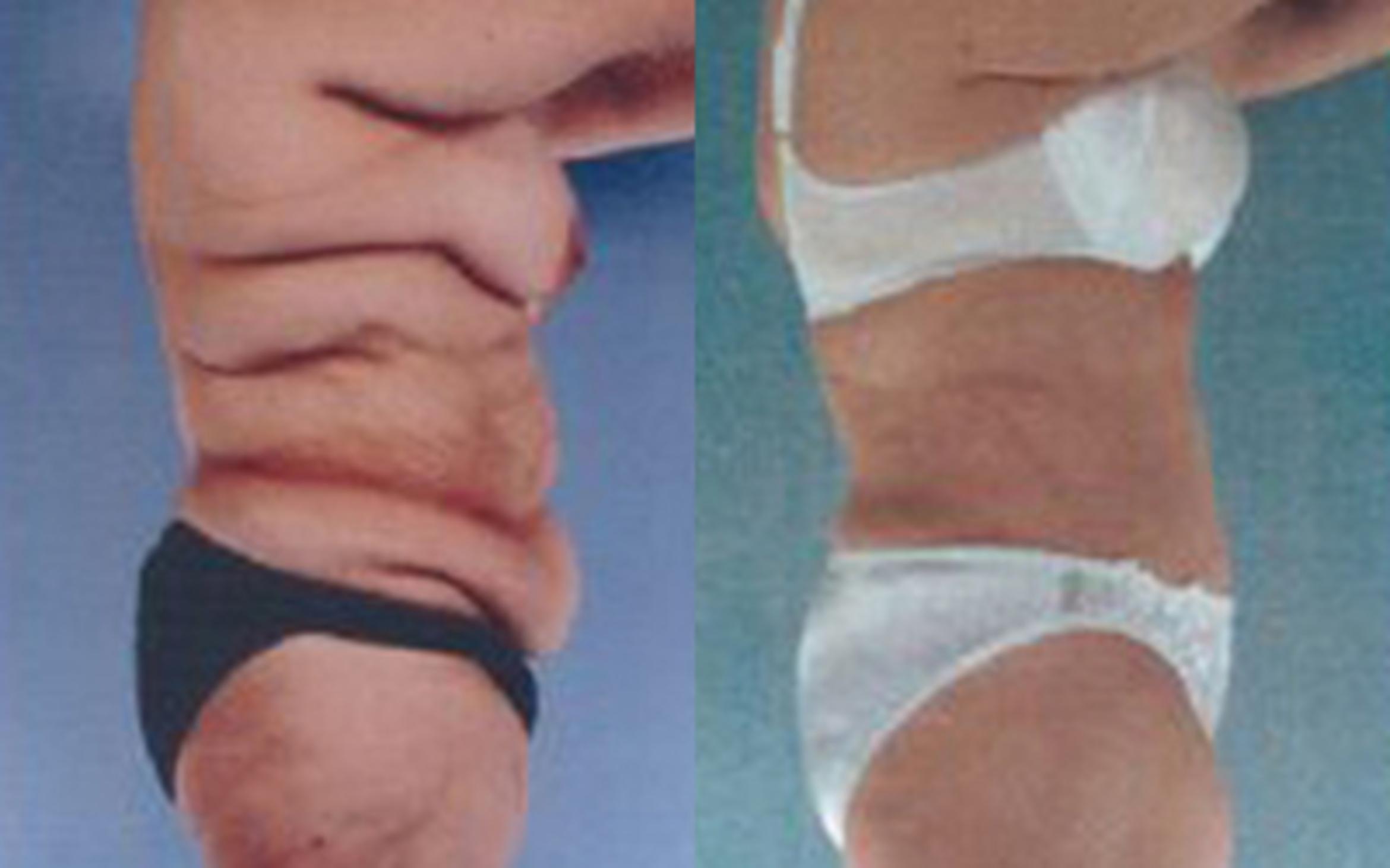 Before & After Tummy Tuck Case 37 View 3 View in Houston, TX