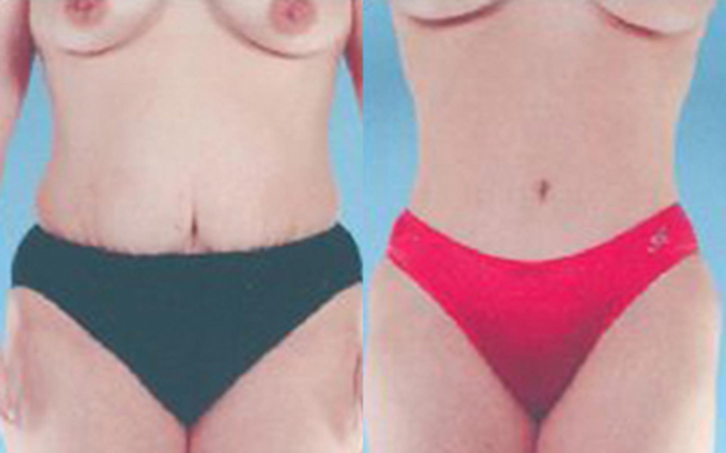 Before & After Tummy Tuck Case 38 View 1 View in Houston, TX
