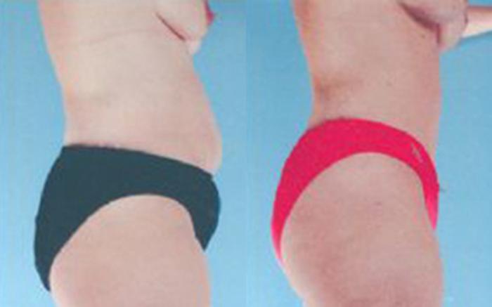 Before & After Tummy Tuck Case 38 View 2 View in Houston, TX