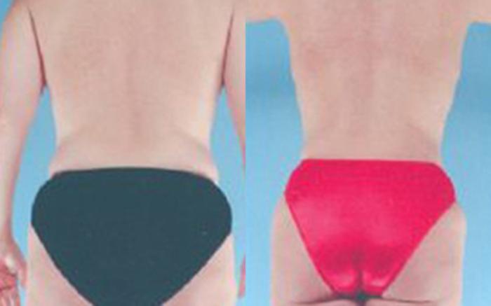 Before & After Tummy Tuck Case 38 View 3 View in Houston, TX