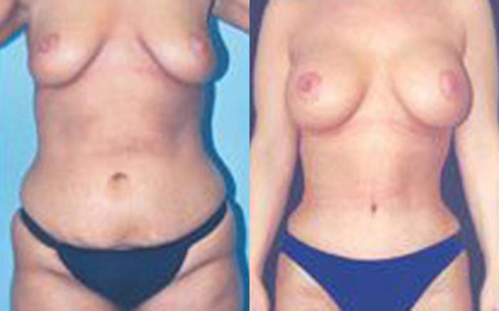 Before & After Tummy Tuck Case 39 View 1 View in Houston, TX