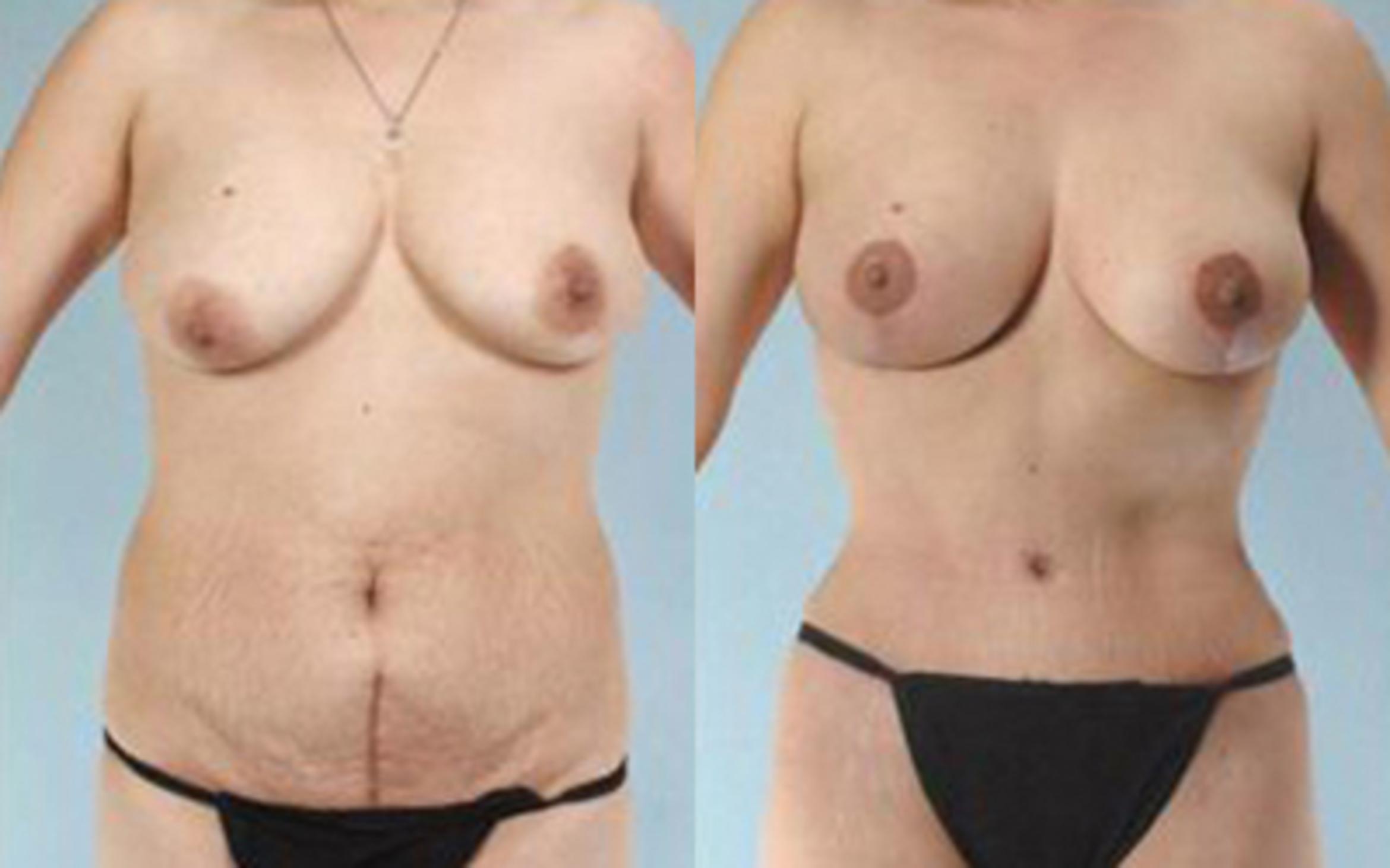 Before & After Tummy Tuck Case 4 View 1 View in Houston, TX