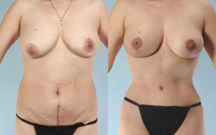 Before & After Tummy Tuck Case 4 View 1 View in Houston, TX