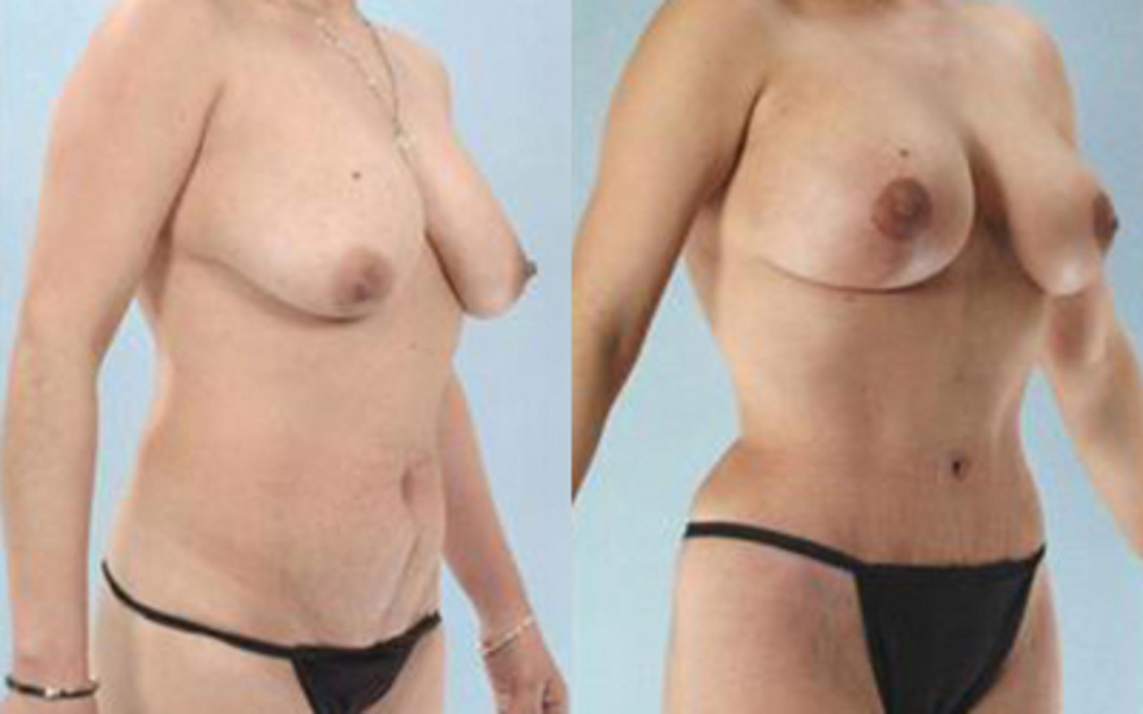 Before & After Tummy Tuck Case 4 View 2 View in Houston, TX