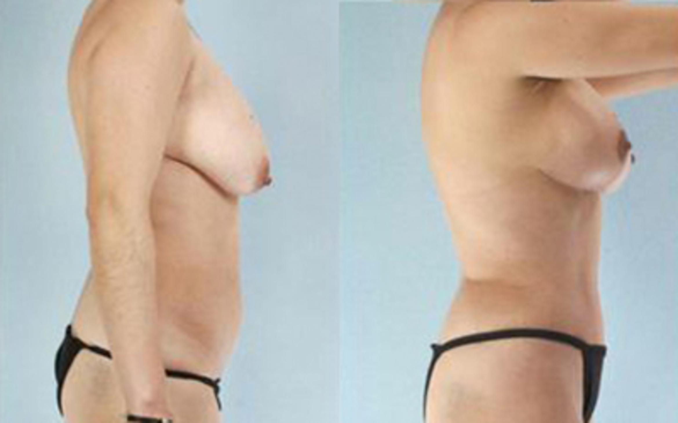 Before & After Tummy Tuck Case 4 View 3 View in Houston, TX