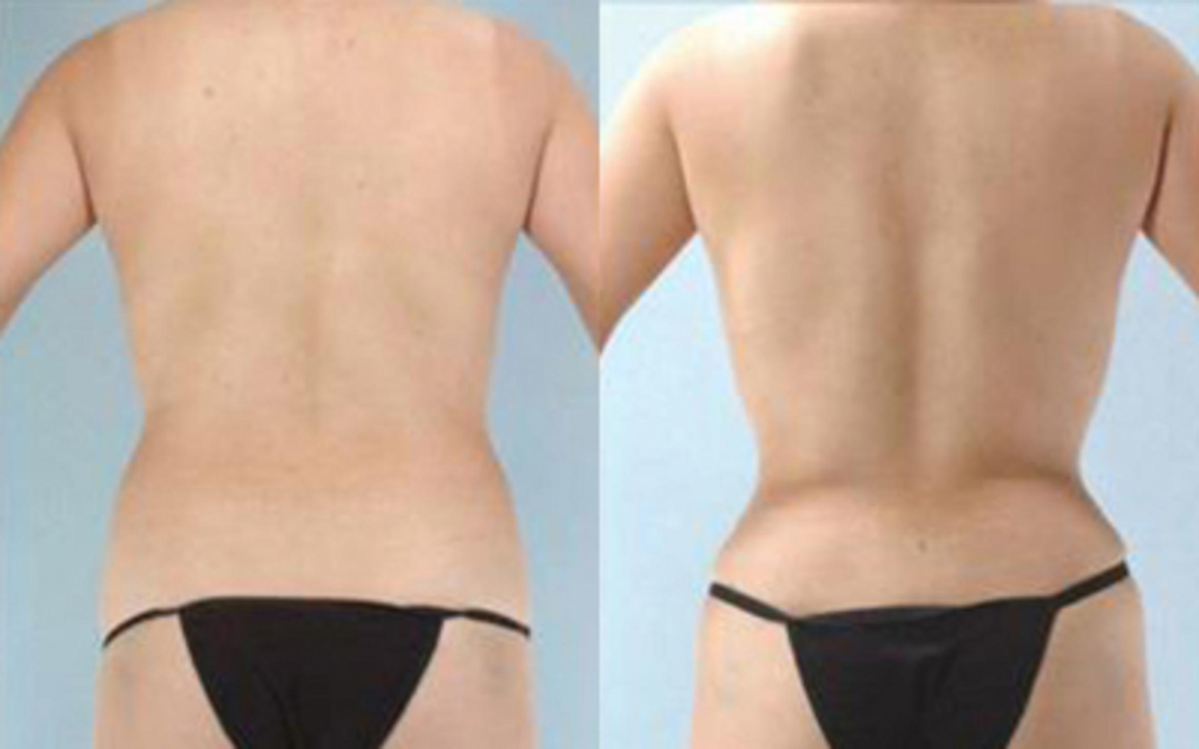 Before & After Tummy Tuck Case 4 View 4 View in Houston, TX