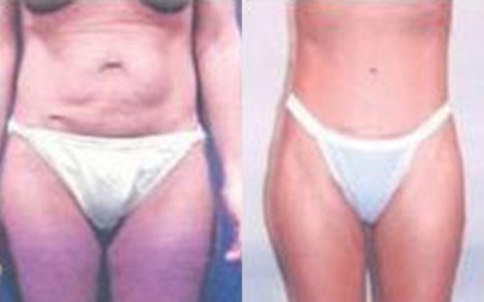 Before & After Tummy Tuck Case 40 View 1 View in Houston, TX