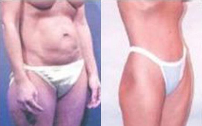 Before & After Tummy Tuck Case 40 View 2 View in Houston, TX