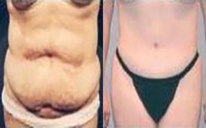 Before & After Tummy Tuck Case 41 View 1 View in Houston, TX