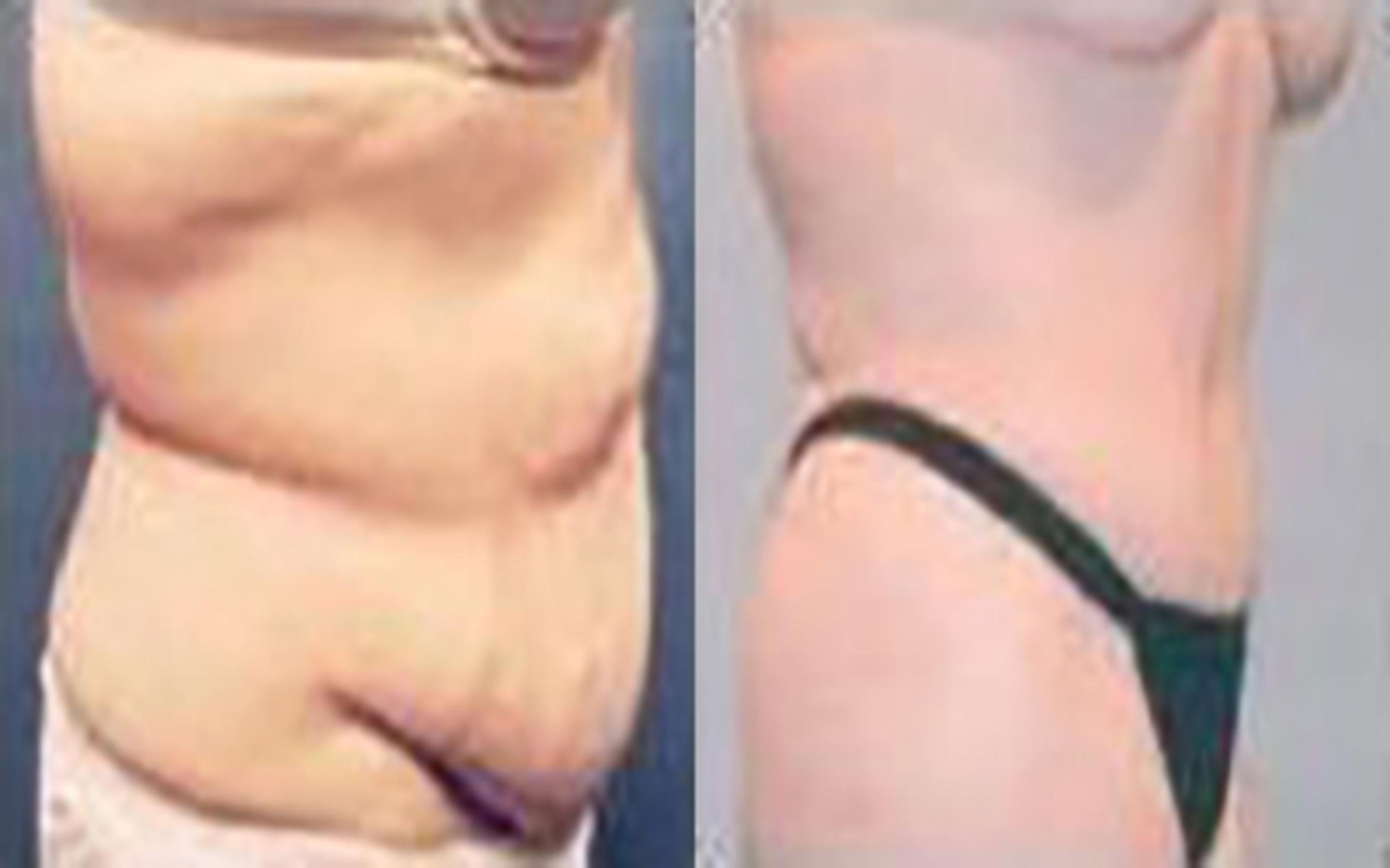 Before & After Tummy Tuck Case 41 View 2 View in Houston, TX