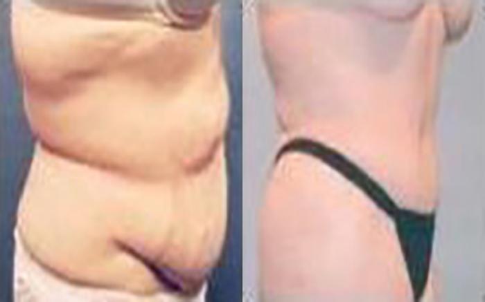 Before & After Tummy Tuck Case 41 View 2 View in Houston, TX