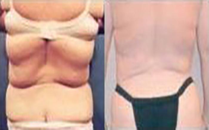 Before & After Tummy Tuck Case 41 View 3 View in Houston, TX
