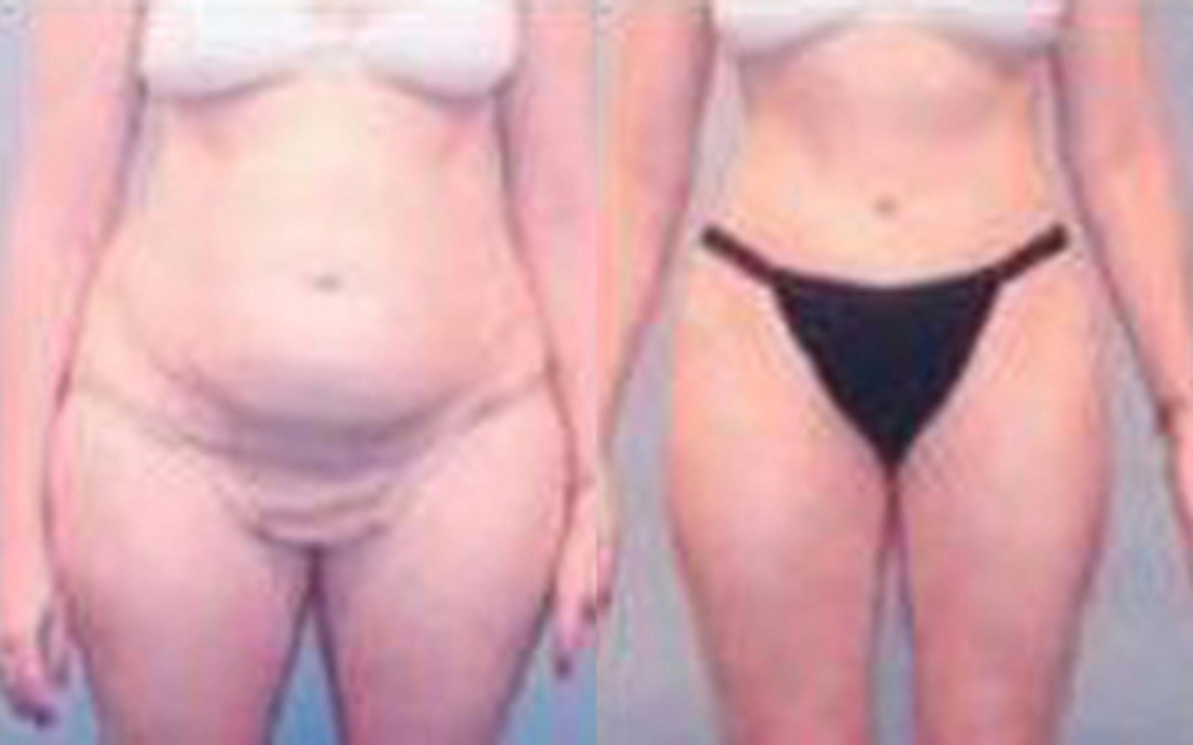 Before & After Tummy Tuck Case 42 View 1 View in Houston, TX