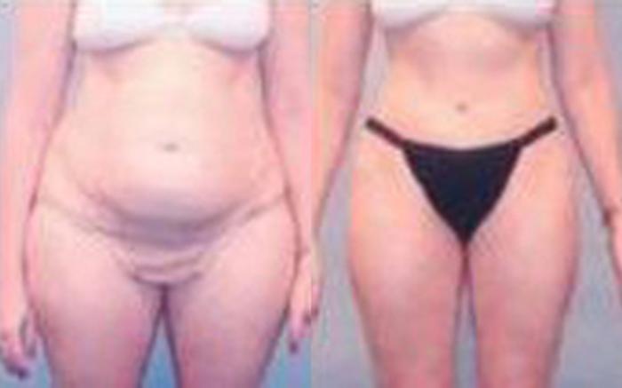 Before & After Tummy Tuck Case 42 View 1 View in Houston, TX