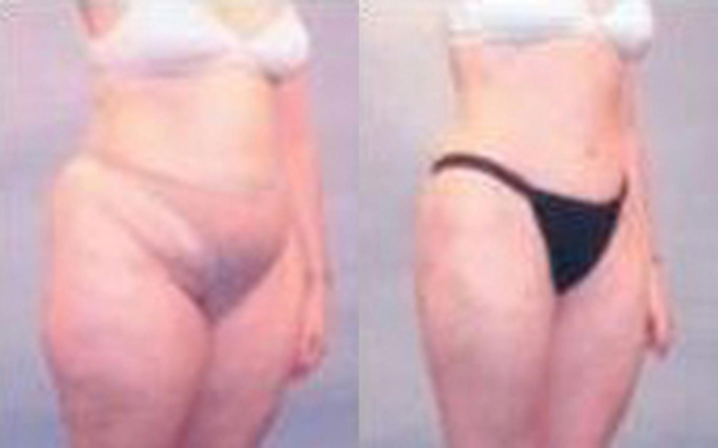 Before & After Tummy Tuck Case 42 View 2 View in Houston, TX