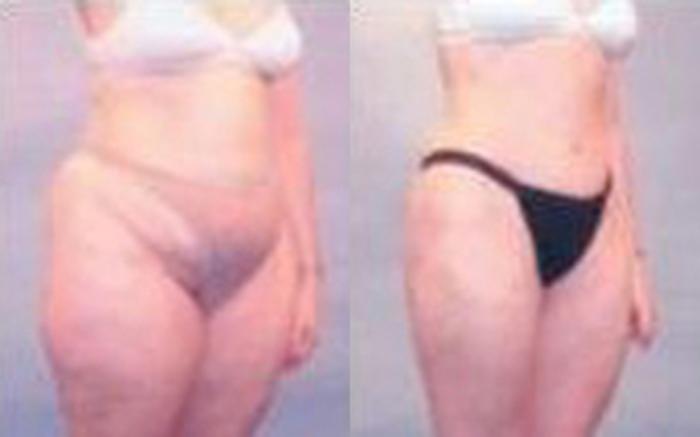 Before & After Tummy Tuck Case 42 View 2 View in Houston, TX