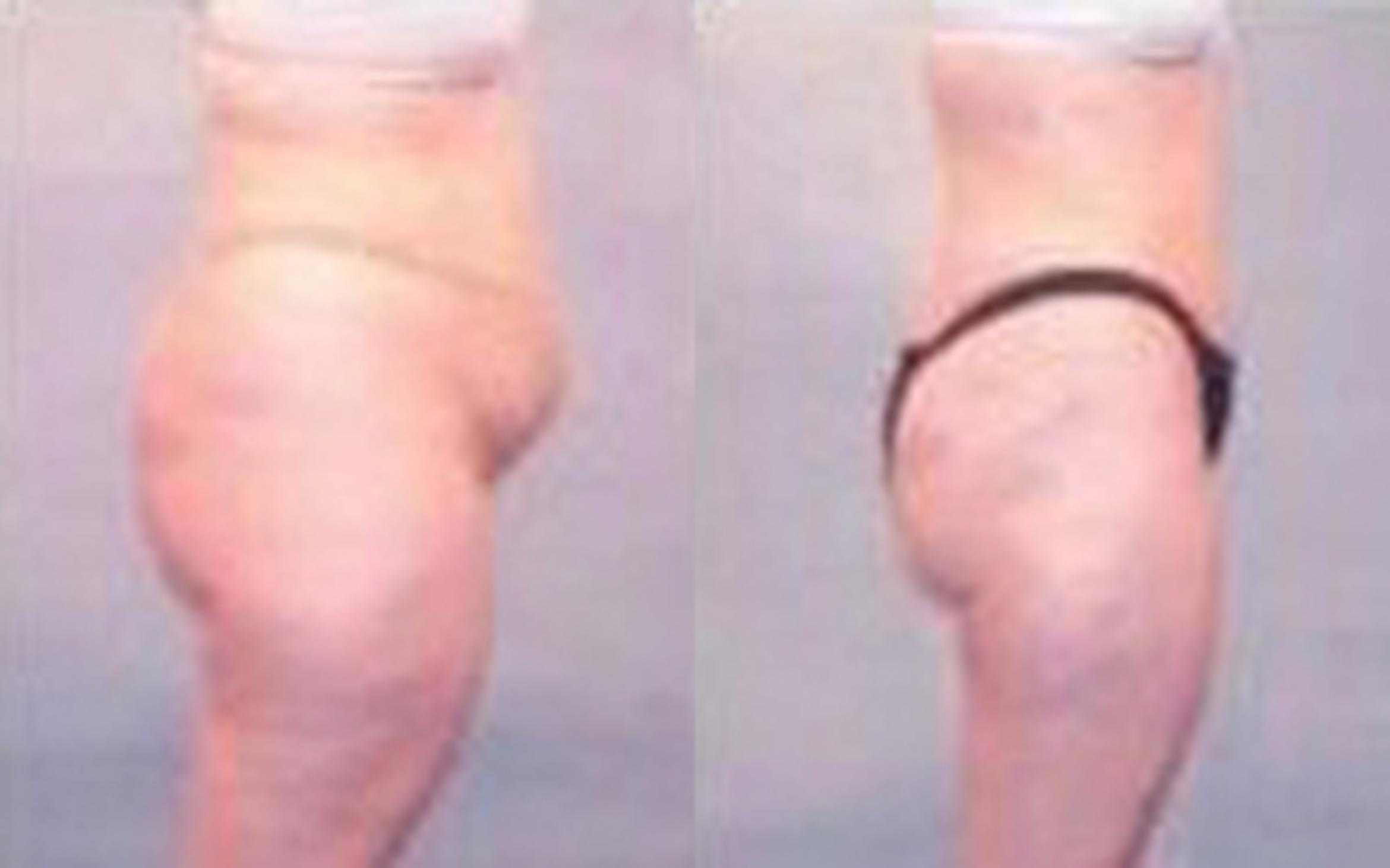 Before & After Tummy Tuck Case 42 View 3 View in Houston, TX