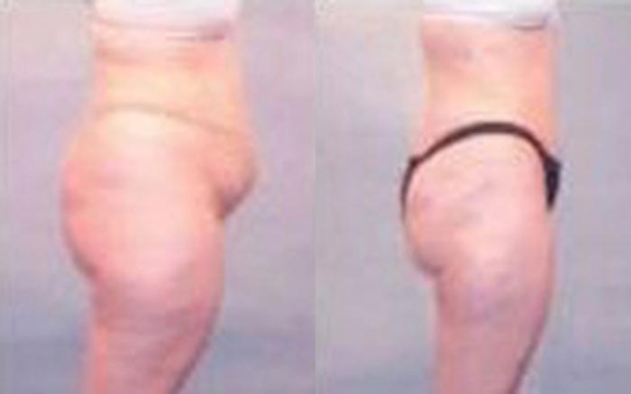Before & After Tummy Tuck Case 42 View 3 View in Houston, TX
