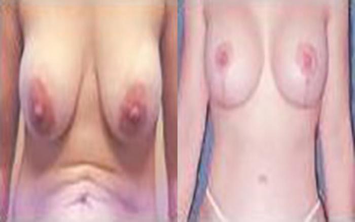 Before & After Tummy Tuck Case 43 View 1 View in Houston, TX
