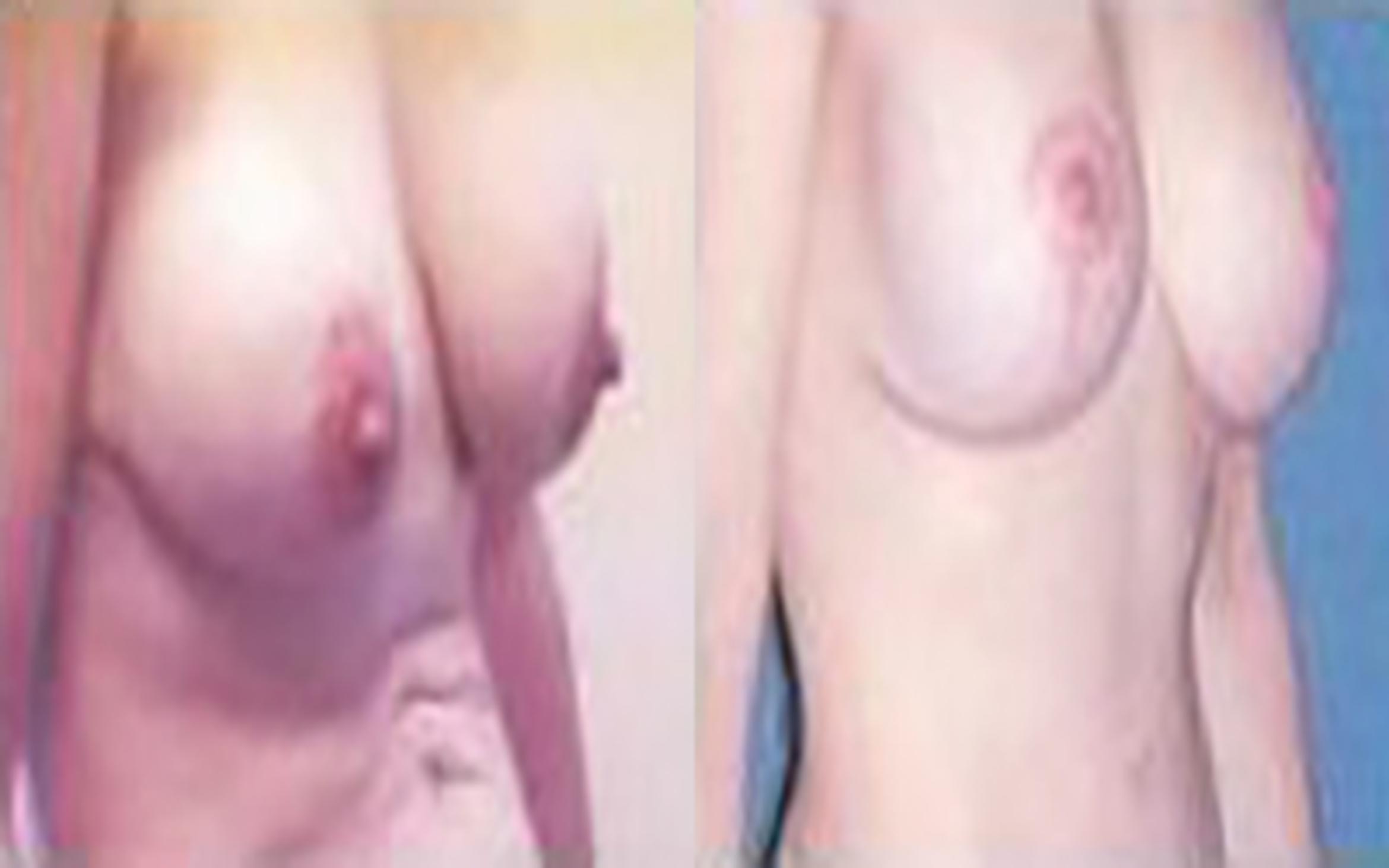 Before & After Tummy Tuck Case 43 View 2 View in Houston, TX