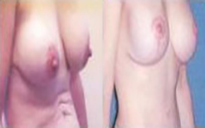 Before & After Tummy Tuck Case 43 View 2 View in Houston, TX
