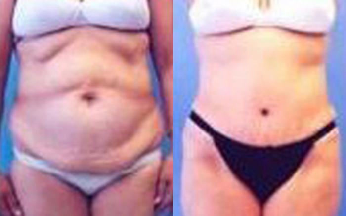 Before & After Tummy Tuck Case 44 View 1 View in Houston, TX