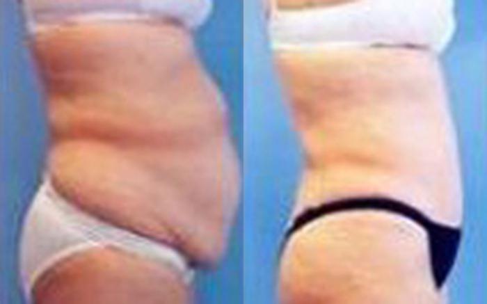 Before & After Tummy Tuck Case 44 View 2 View in Houston, TX