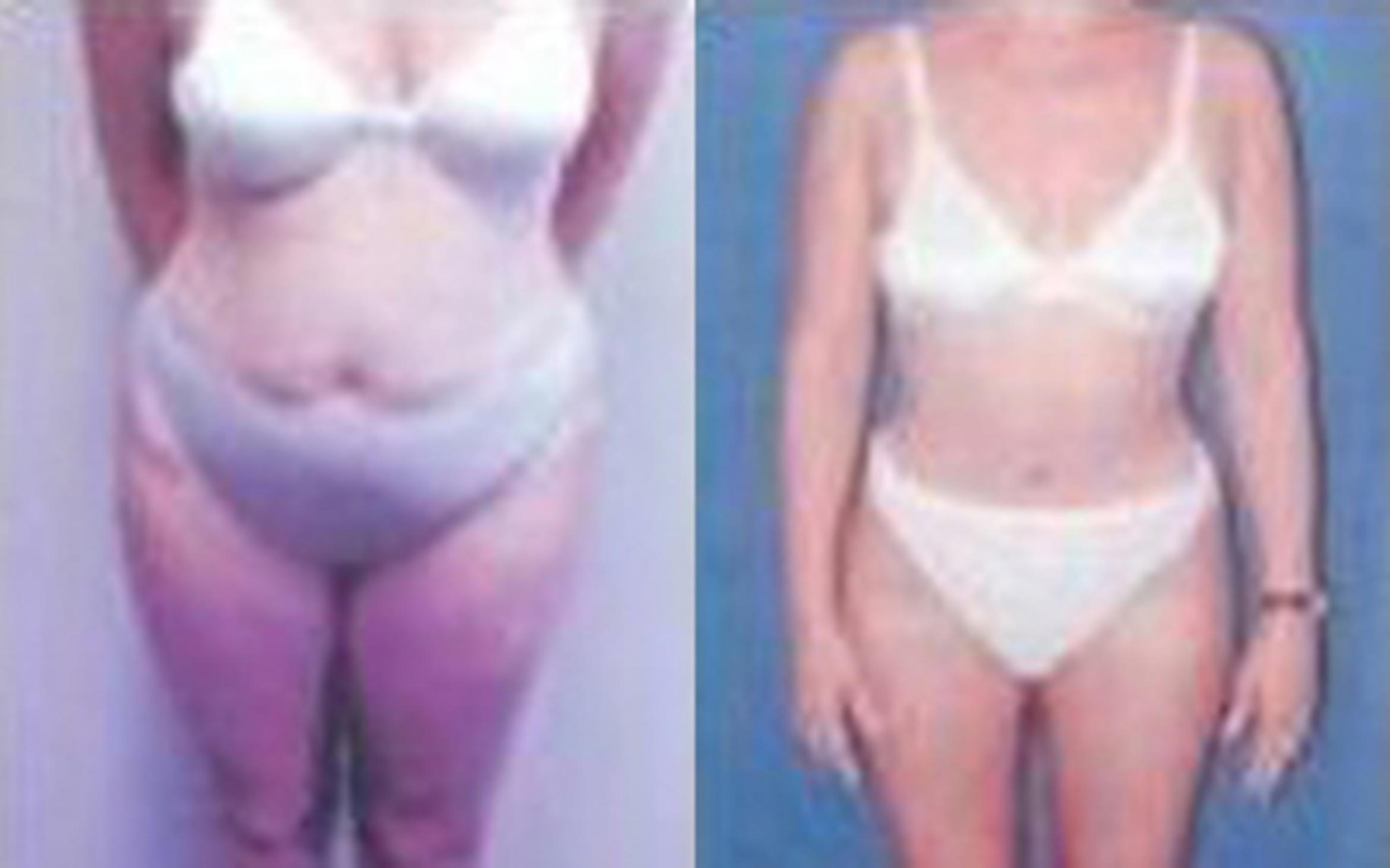 Before & After Tummy Tuck Case 45 View 1 View in Houston, TX