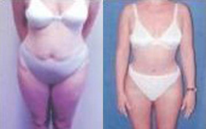 Before & After Tummy Tuck Case 45 View 1 View in Houston, TX