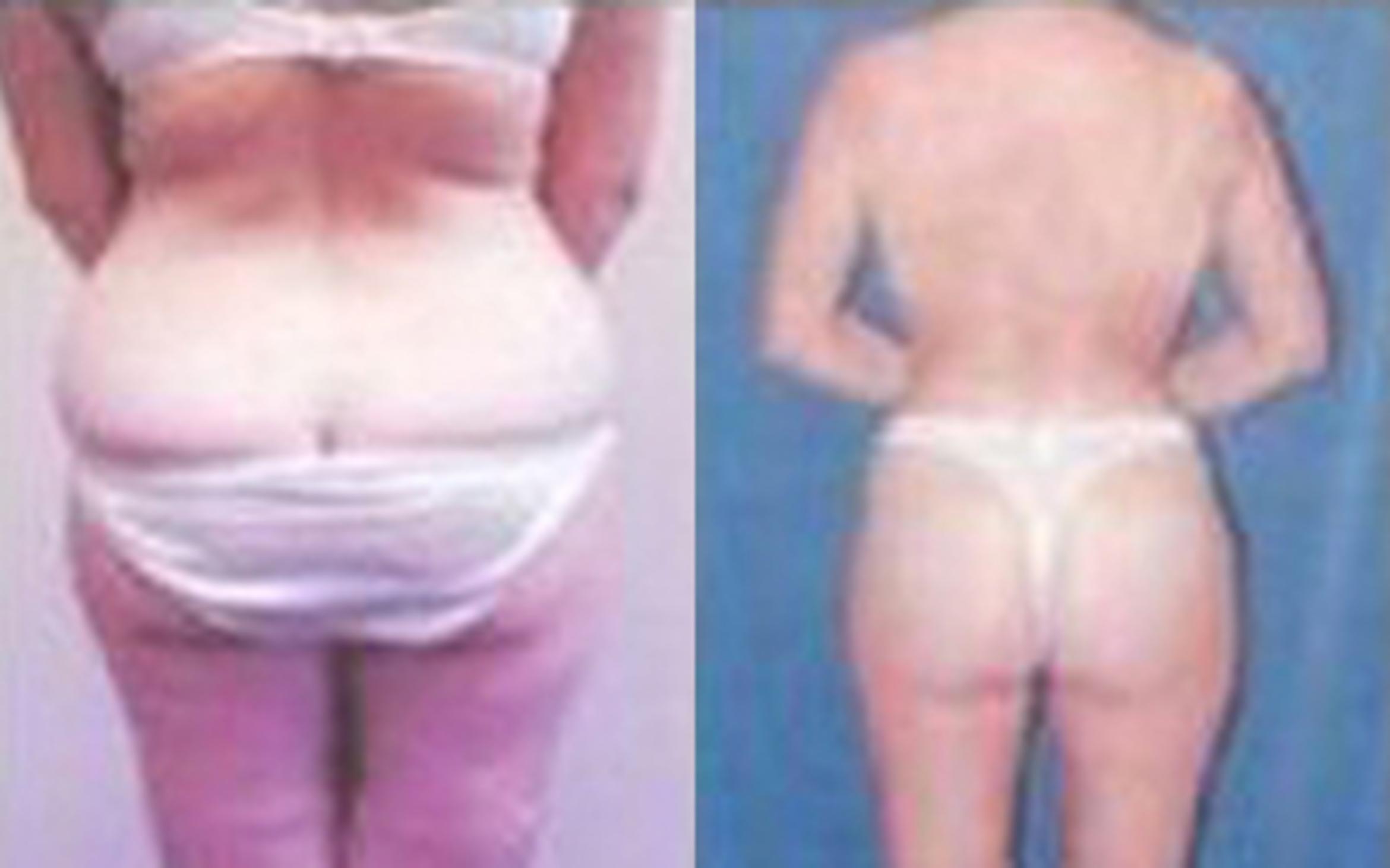 Before & After Tummy Tuck Case 45 View 2 View in Houston, TX