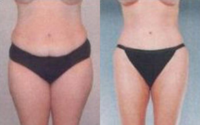 Before & After Tummy Tuck Case 46 View 1 View in Houston, TX