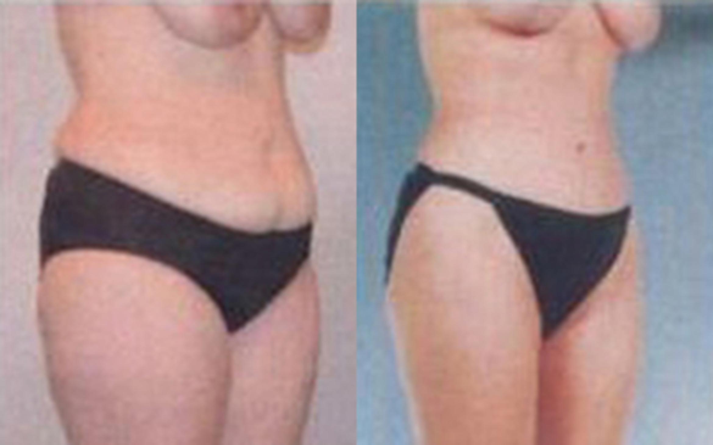 Before & After Tummy Tuck Case 46 View 2 View in Houston, TX