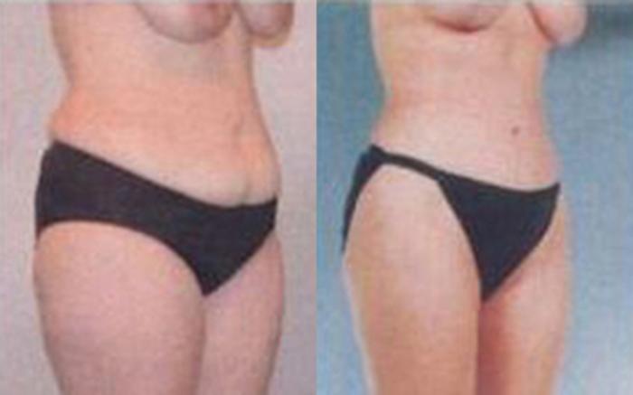 Before & After Tummy Tuck Case 46 View 2 View in Houston, TX