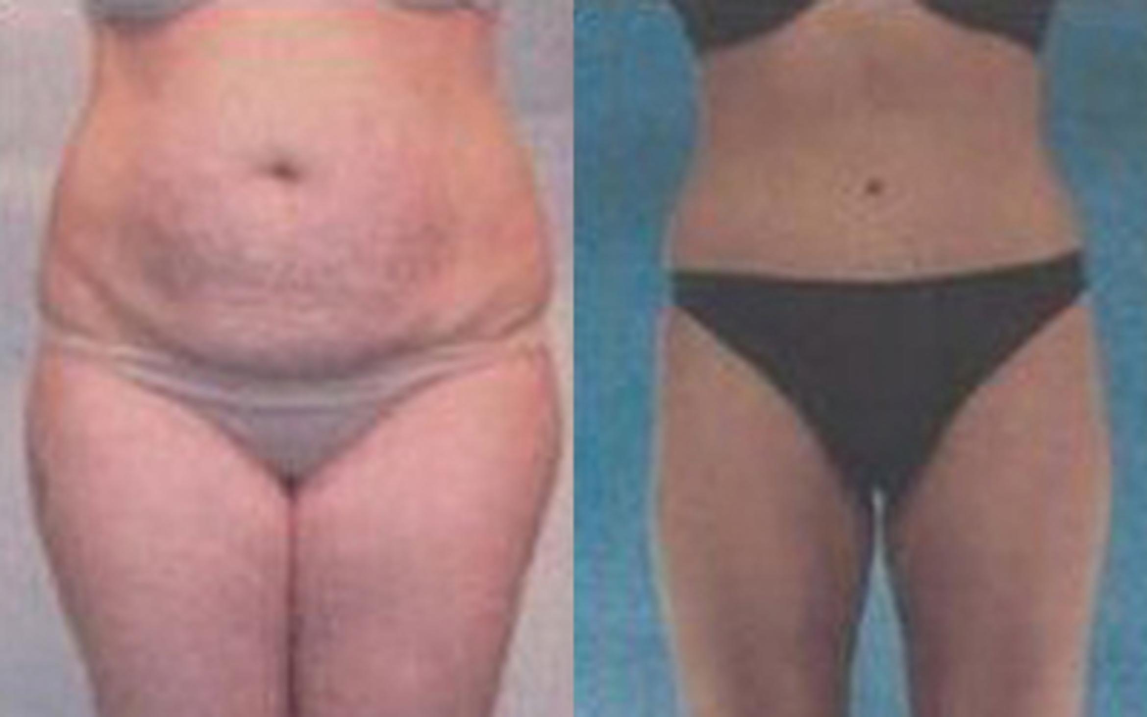 Before & After Tummy Tuck Case 47 View 1 View in Houston, TX