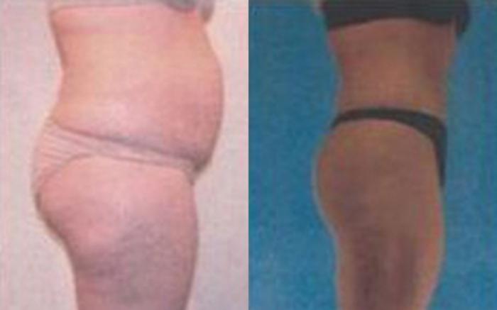 Before & After Tummy Tuck Case 47 View 2 View in Houston, TX