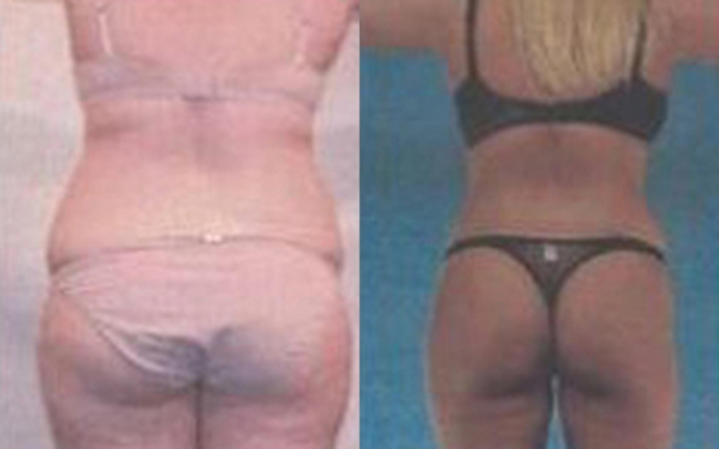 Before & After Tummy Tuck Case 47 View 3 View in Houston, TX