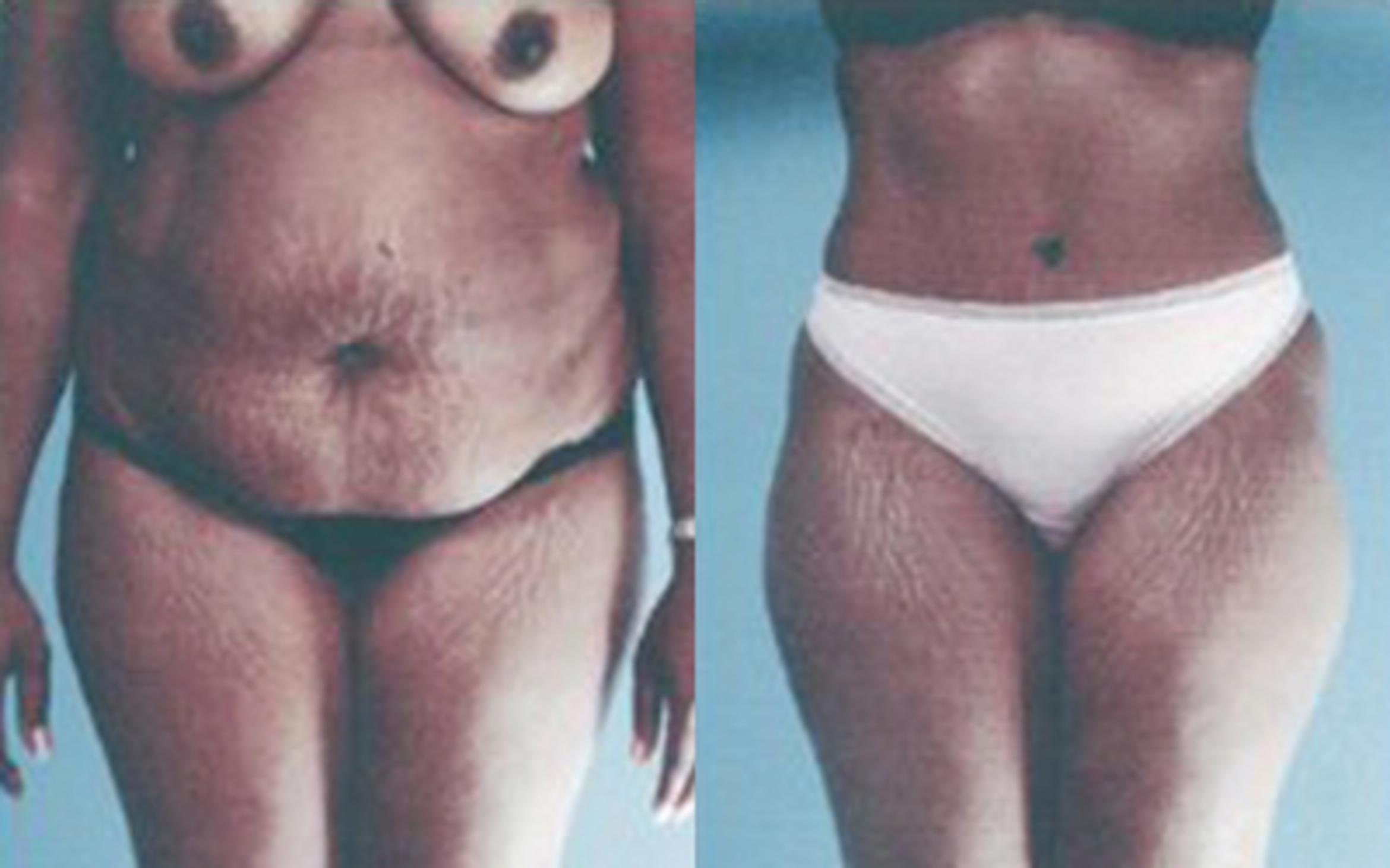 Before & After Tummy Tuck Case 48 View 1 View in Houston, TX
