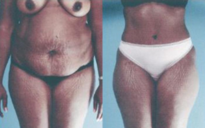 Before & After Tummy Tuck Case 48 View 1 View in Houston, TX