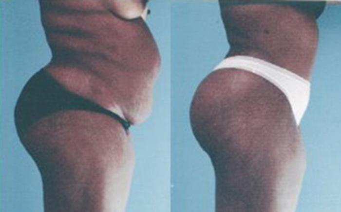 Before & After Tummy Tuck Case 48 View 2 View in Houston, TX