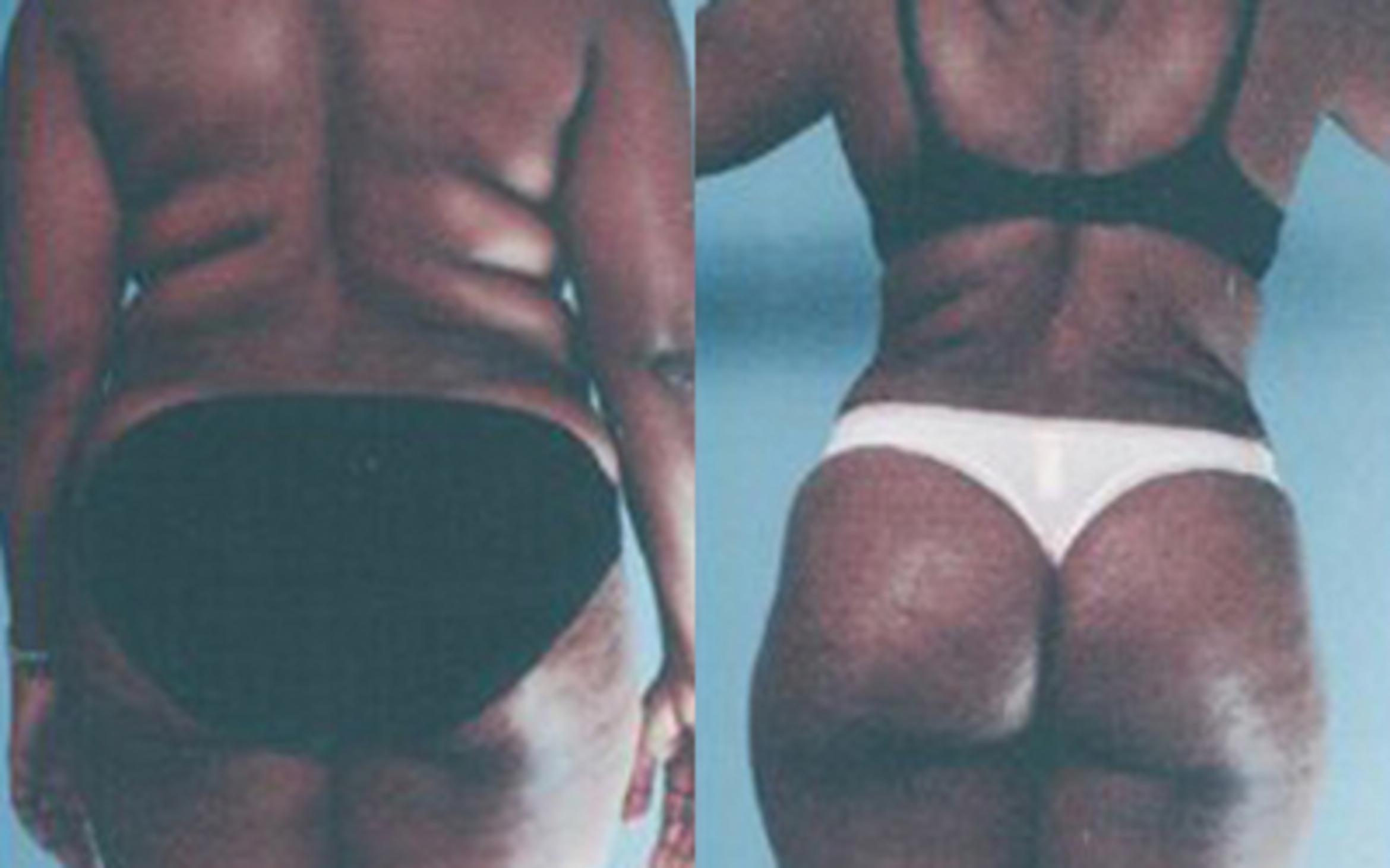 Before & After Tummy Tuck Case 48 View 3 View in Houston, TX