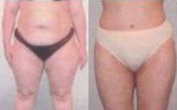 Before & After Tummy Tuck Case 49 View 1 View in Houston, TX