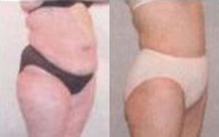 Before & After Tummy Tuck Case 49 View 2 View in Houston, TX