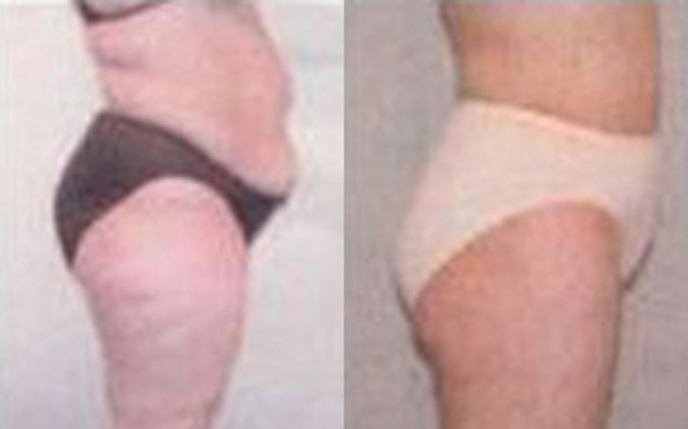 Before & After Tummy Tuck Case 49 View 3 View in Houston, TX