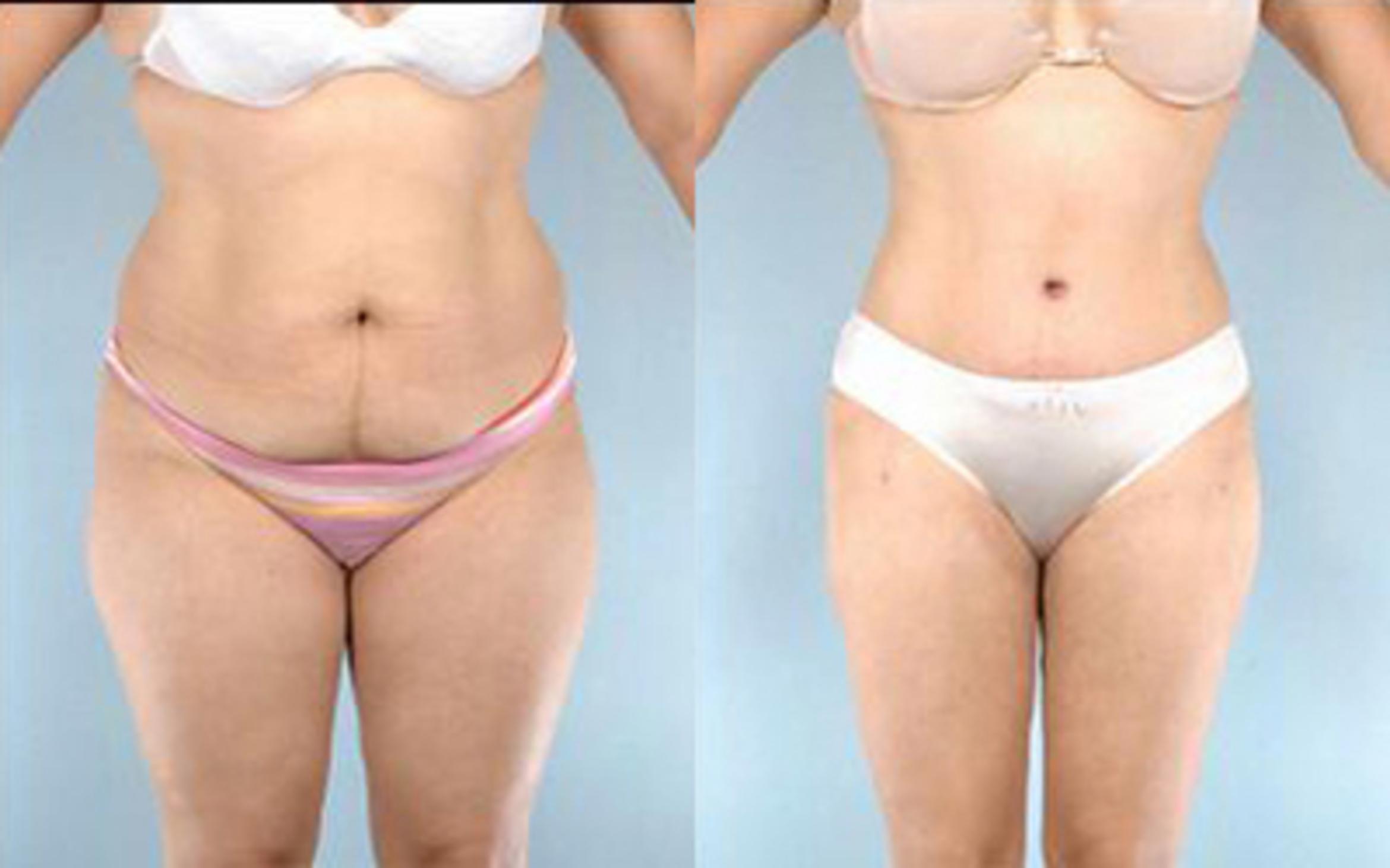 Before & After Tummy Tuck Case 5 View 1 View in Houston, TX